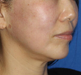 50代女性の After 症例写真