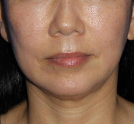 50代女性の Before 症例写真