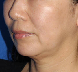 50代女性のシワ・たるみ Before 症例写真