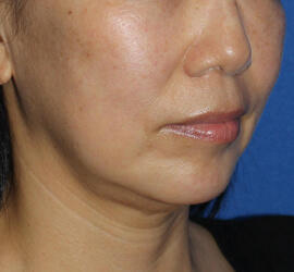 50代女性の Before 症例写真