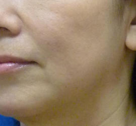 50代女性のリジュランHB After 症例写真