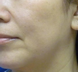 50代女性のリジュランHB Before 症例写真