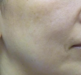 50代女性のリジュランHB Before 症例写真