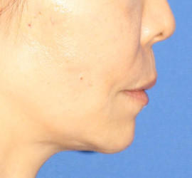50代女性のヒアルロン酸注射（アゴ形成） After 症例写真