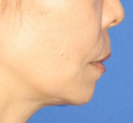 50代女性のヒアルロン酸注射（アゴ形成） Before 症例写真