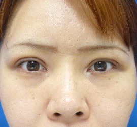30代女性の上まぶたのたるみ取り After 症例写真