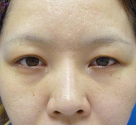 30代女性の上まぶたのたるみ取り Before 症例写真