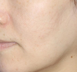 40代女性のメディカル美肌セレクト After 症例写真