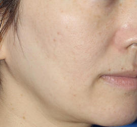 40代女性のメディカル美肌セレクト After 症例写真