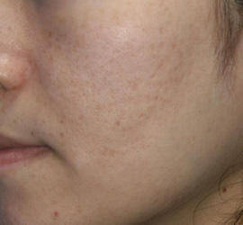 40代女性のメディカル美肌セレクト Before 症例写真