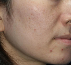 40代女性のメディカル美肌セレクト Before 症例写真