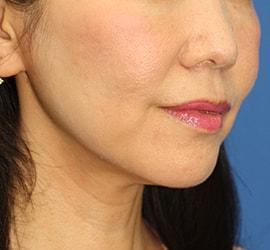 40代女性のサーマクール After 症例写真