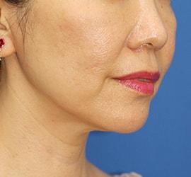 40代女性のサーマクール Before 症例写真