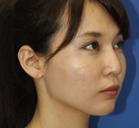 30代女性の鼻の整形 After 症例写真