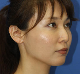30代女性の鼻の整形 Before 症例写真