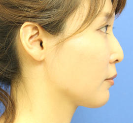 30代女性のヒアルロン酸注射（鼻形成） Before 症例写真