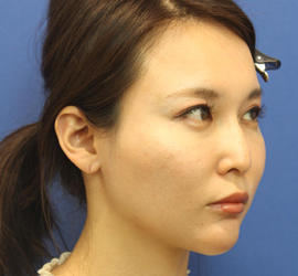 30代女性のヒアルロン酸骨格リフト After 症例写真