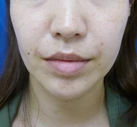 30代女性のサーマクール After 症例写真
