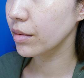 30代女性のサーマクール After 症例写真