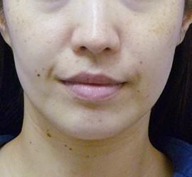 30代女性のサーマクール Before 症例写真