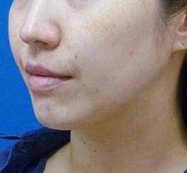 30代女性のサーマクール Before 症例写真