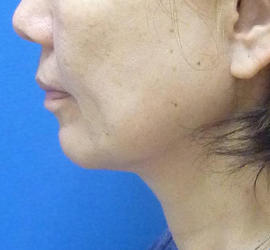 50代女性のボトックス（輪郭＆広頚筋ボトックス） After 症例写真