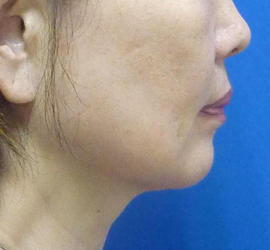 50代女性のボトックス（輪郭＆広頚筋ボトックス） After 症例写真