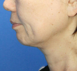 50代女性のボトックス（輪郭＆広頚筋ボトックス） Before 症例写真