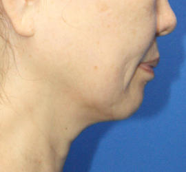 50代女性のボトックス（輪郭＆広頚筋ボトックス） Before 症例写真