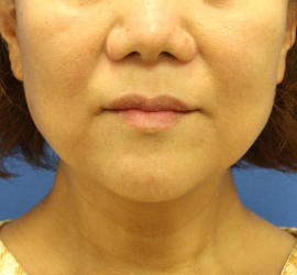 50代女性のボトックス（輪郭＆広頚筋ボトックス） After 症例写真