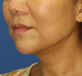 50代女性のボトックス（輪郭＆広頚筋ボトックス） After 症例写真