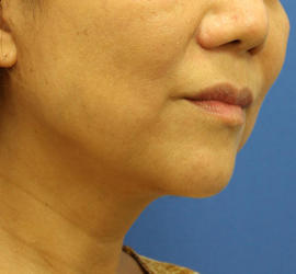 50代女性のボトックス（輪郭＆広頚筋ボトックス） After 症例写真