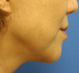 50代女性のボトックス（輪郭＆広頚筋ボトックス） After 症例写真