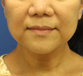 50代女性のボトックス（輪郭＆広頚筋ボトックス） Before 症例写真