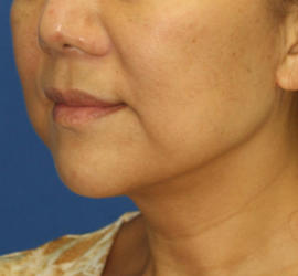 50代女性のボトックス（輪郭＆広頚筋ボトックス） Before 症例写真