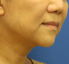 50代女性のボトックス（輪郭＆広頚筋ボトックス） Before 症例写真