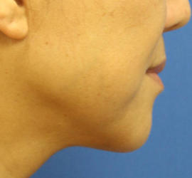 50代女性のボトックス（輪郭＆広頚筋ボトックス） Before 症例写真