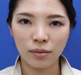 30代女性のシワ・たるみ After 症例写真