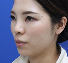 30代女性の After 症例写真