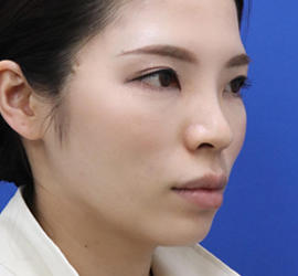 30代女性の After 症例写真