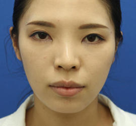 30代女性のシワ・たるみ Before 症例写真