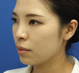 30代女性の Before 症例写真