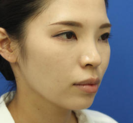 30代女性の Before 症例写真