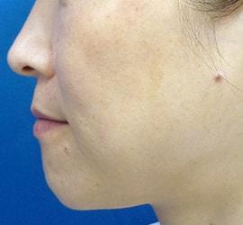 40代女性のリジュランHB After 症例写真