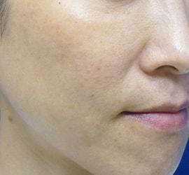 40代女性のリジュランHB After 症例写真