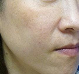 40代女性のリジュランHB Before 症例写真