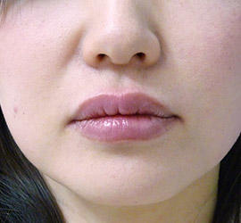 40代女性のヒアルロン酸注射（唇） After 症例写真