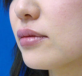 40代女性のヒアルロン酸注射（唇） After 症例写真