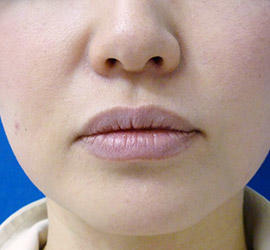 40代女性のヒアルロン酸注射（唇） Before 症例写真