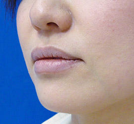 40代女性のヒアルロン酸注射（唇） Before 症例写真